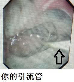 胸水为什么会抽不到,胸水抽了为什么还呼吸困难