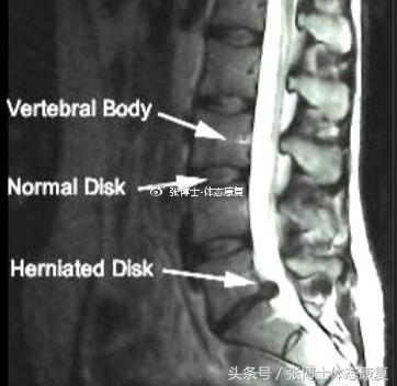 运动康复学治疗腰间盘突出,运动康复腰椎间盘突出