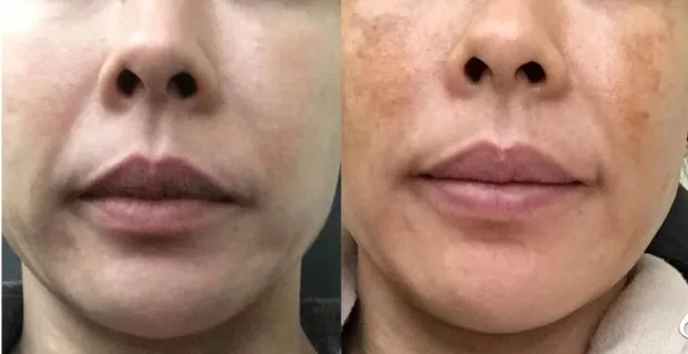 坚持7天的细纹消失,没有细纹但是有斑点