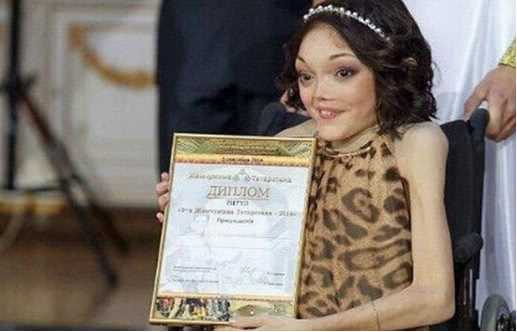 海豹畸形婴儿长大,海豹畸形宝宝