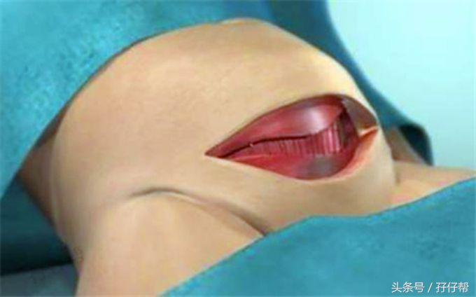 二胎剖腹产的真实经历,双胎妈妈怀孕的痛苦