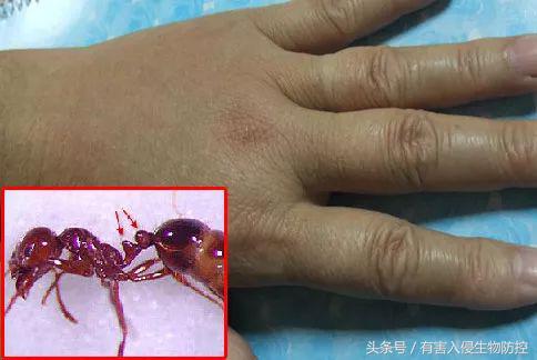 被红火蚁咬了怎样治疗,被红火蚁咬怎么治疗