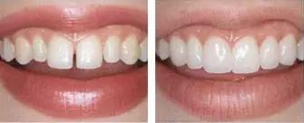 牙齿松动还有缝越来越大,牙齿太稀牙小缝大怎么矫正