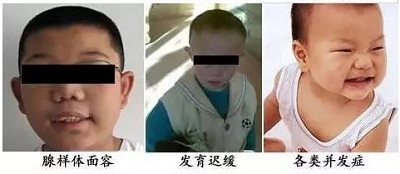 小孩子讲话出现鼻音，可能是腺样体肥大