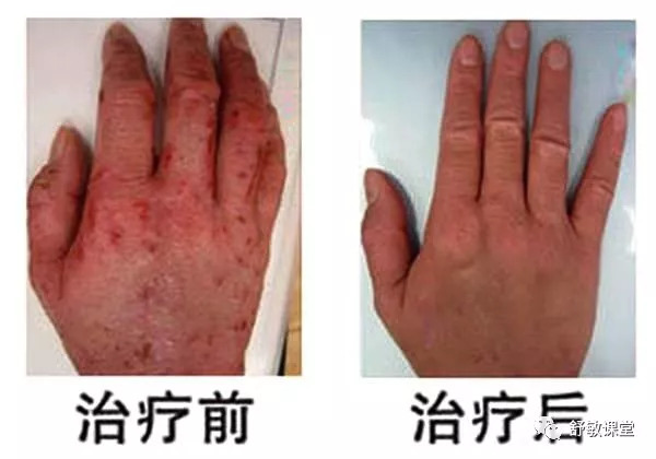 孕期湿疹长期用激素药膏有影响吗,孕妇脚湿疹擦什么药膏好