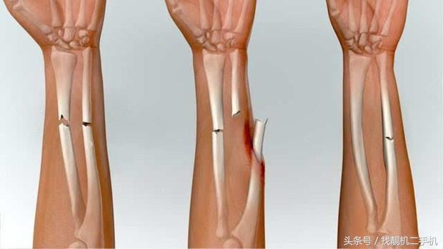 骨头碎裂怎么修复最好,骨头碎裂能自愈吗