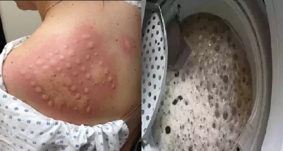 惊天黑幕！HM，ZARA等快时尚品牌的牛仔裤，已导致多*皮人**肤腐烂，恶臭，不孕...