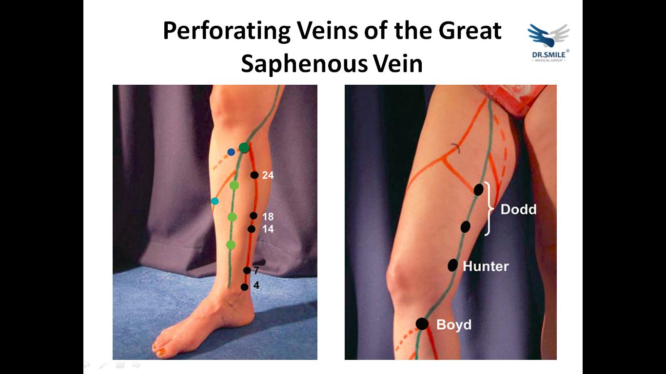 静脉曲张详细解说,静脉曲张知识大全书籍