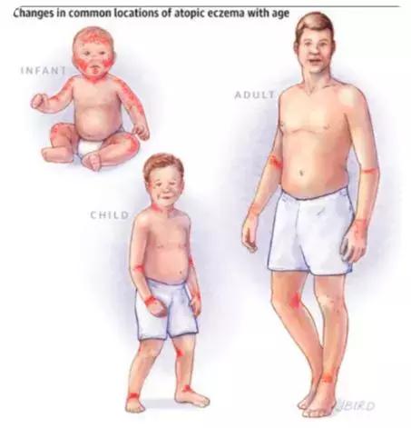 宝宝湿疹康复的全过程,宝宝湿疹不严重也不见好