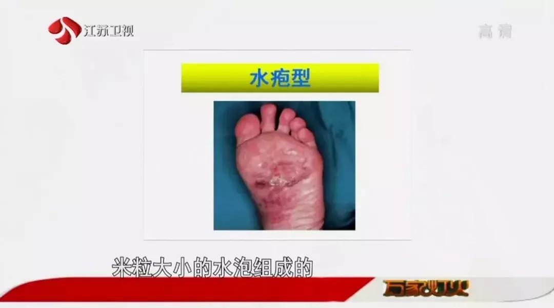经常去足疗会得脚气吗,去洗脚感染脚气怎么办