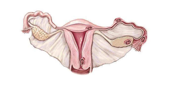 聊聊“子宫肌瘤”那些事儿