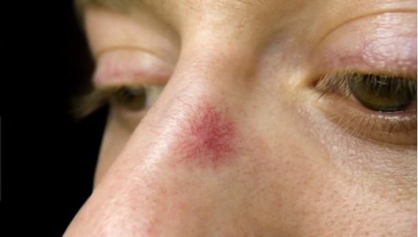 肝硬化的皮肤症状有哪些,肝硬化最怕的四种东西