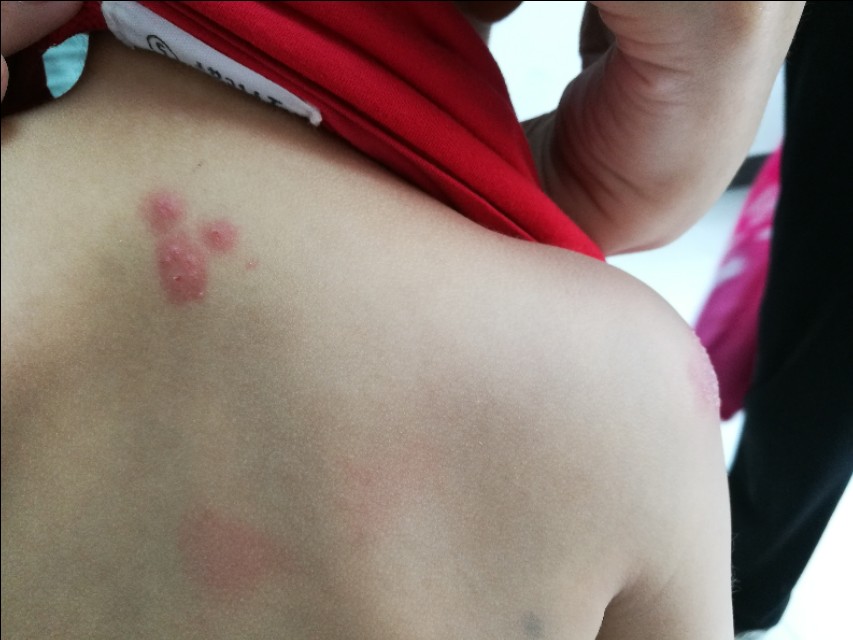 宝宝得了带状疱疹还会长水痘吗,5个月的宝宝会得带状疱疹么