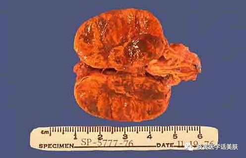 「杏林微科普」带您了解：中医穴位埋线