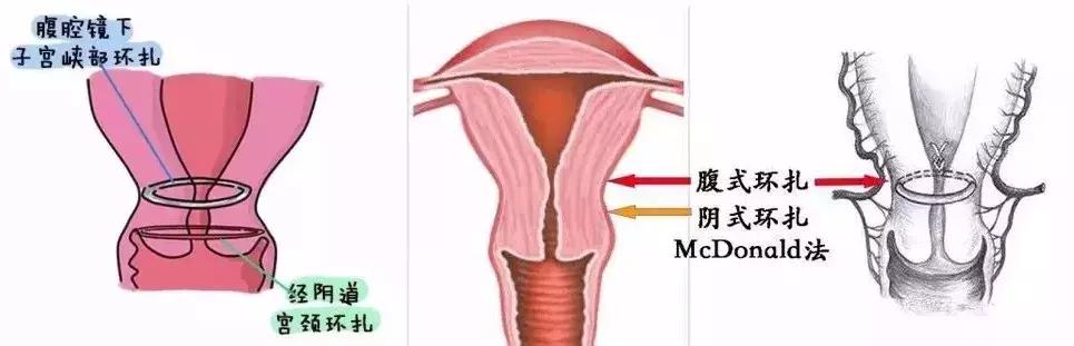 孕早期开了宫口保胎,孕期宫口开保胎