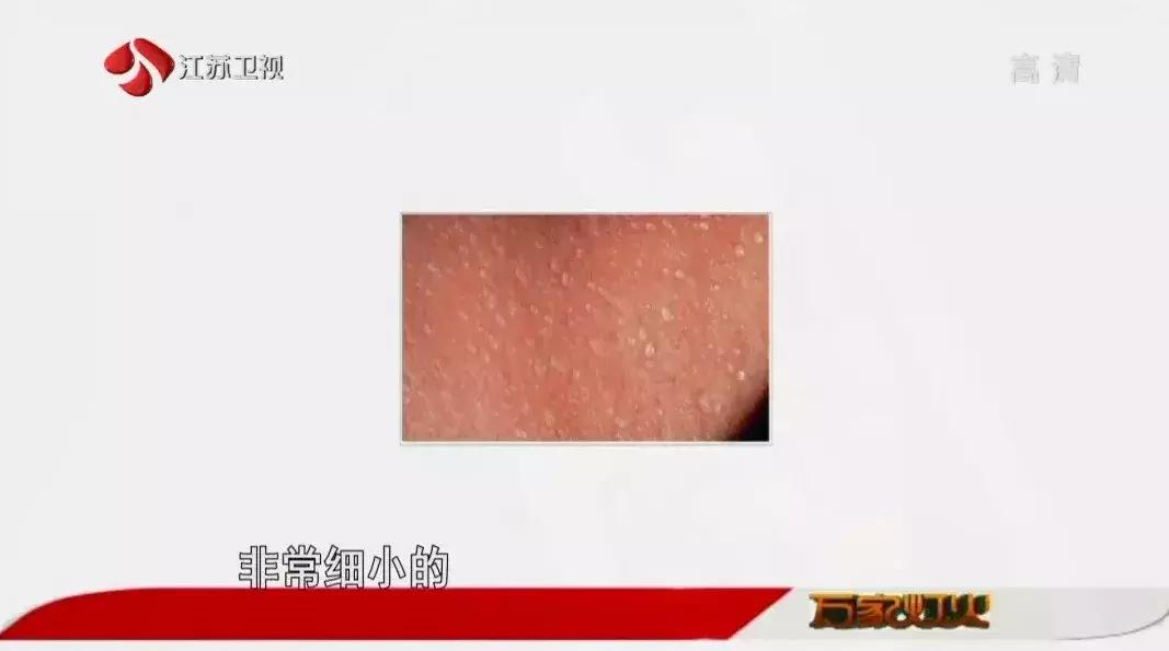 季节更替怎么预防皮肤病,皮肤病痒疹的注意事项