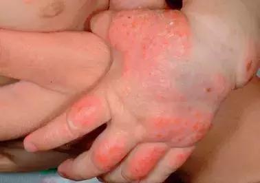 宝宝湿疹终于好了,宝宝湿疹治愈经历