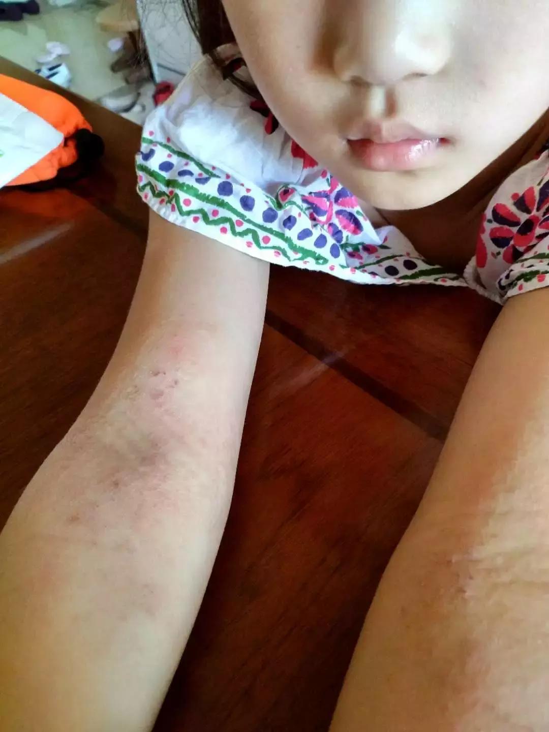 宝宝湿疹终于好了,宝宝湿疹治愈经历