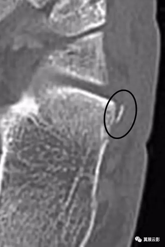 轻微骨裂容易被误诊,临床容易误诊的影像片子