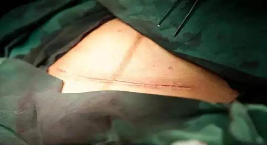 剖腹产一般伤口多久不怎么痛,剖腹产不痛是因为麻药多吗