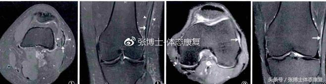 运动康复跑步膝盖疼,髂胫束摩擦综合征还能跑步吗