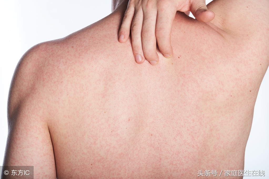 后背长痘有什么解决办法,后背爱长痘中医调理