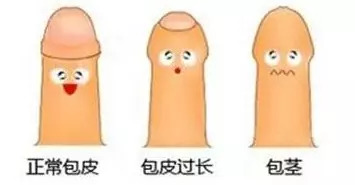 了解男性包皮环切术,了解割包皮