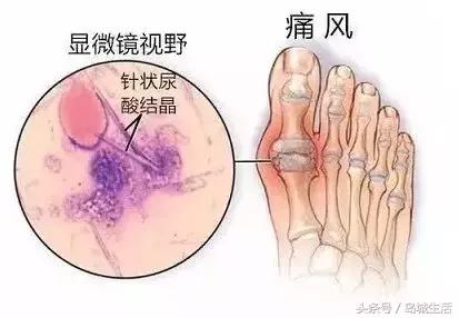 痛风久治不愈怎么办,痛风治疗这四件事真的很重要