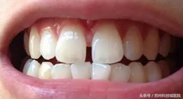 门牙有道缝，美丽关不住