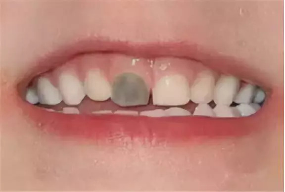 几岁的儿童牙齿就烂了是什么原因,宝宝牙齿烂光了只剩下牙根怎么办