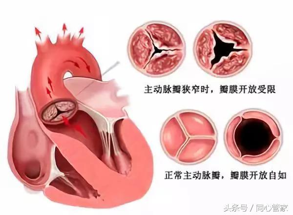 血管变窄警惕四种表现,血管脆如何自救