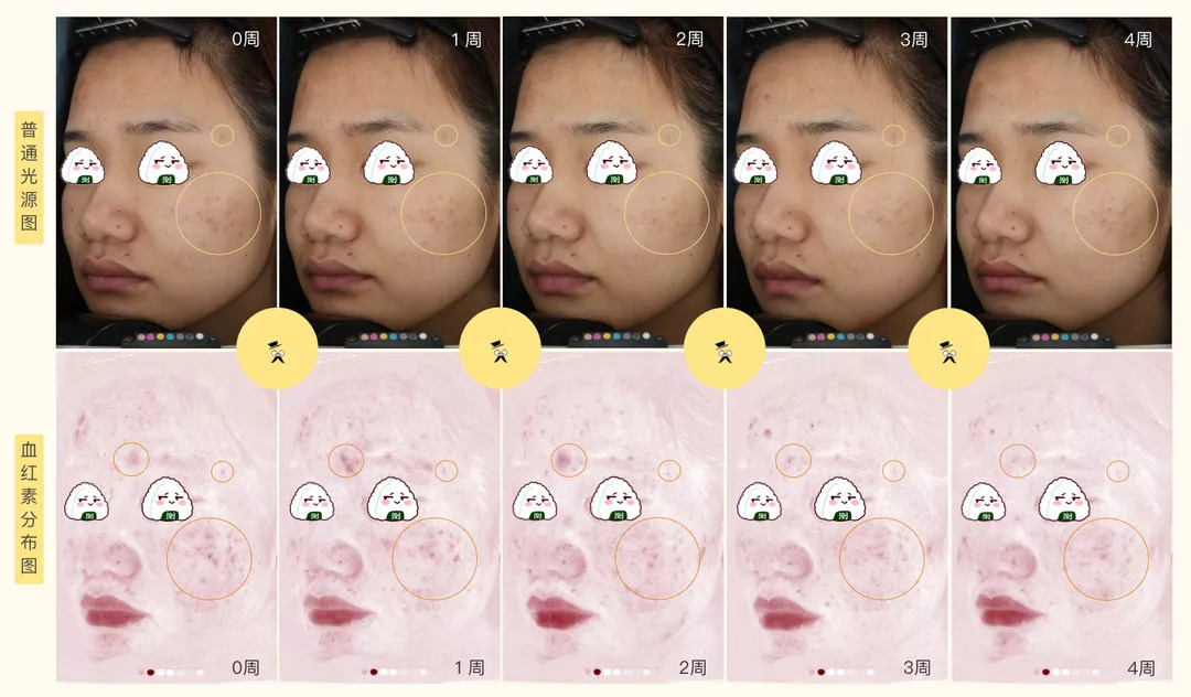 30天花80块去掉陈年老痘印到底有没有可能？