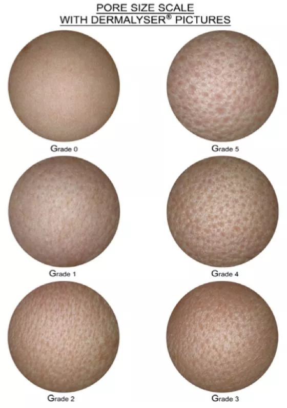 如何拯救已经粗大的毛孔,怎么能拯救面颊毛孔粗大