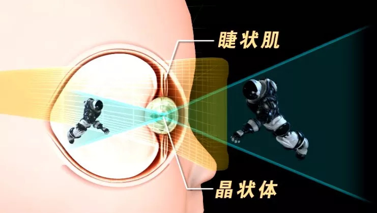 青少年近视弱视矫正,儿童近视1000多度加弱视能治好吗