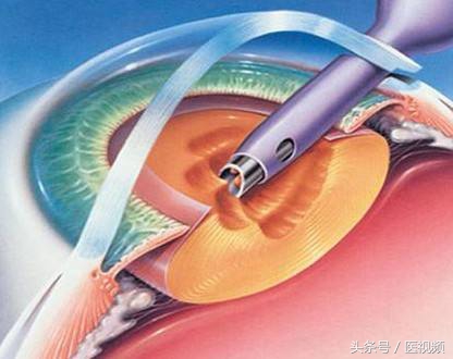 拨开层层迷雾真相就在眼前,揭秘白内障你真的了解它吗