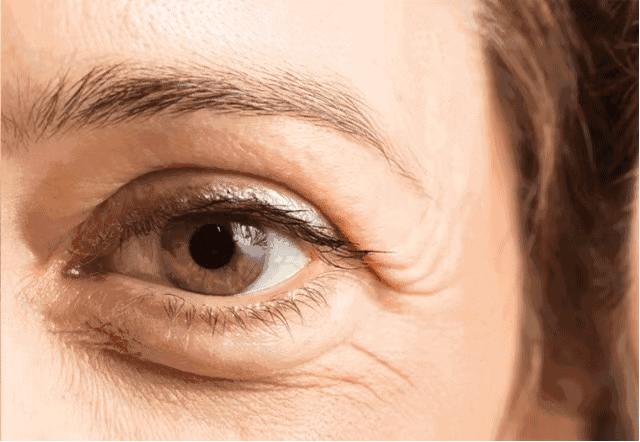 解决黑眼圈细纹最有效的方法,黑眼圈细纹比较严重怎么办