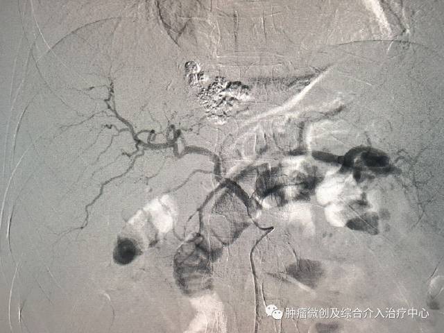 肝癌介入射频消融,肝癌微创消融手术