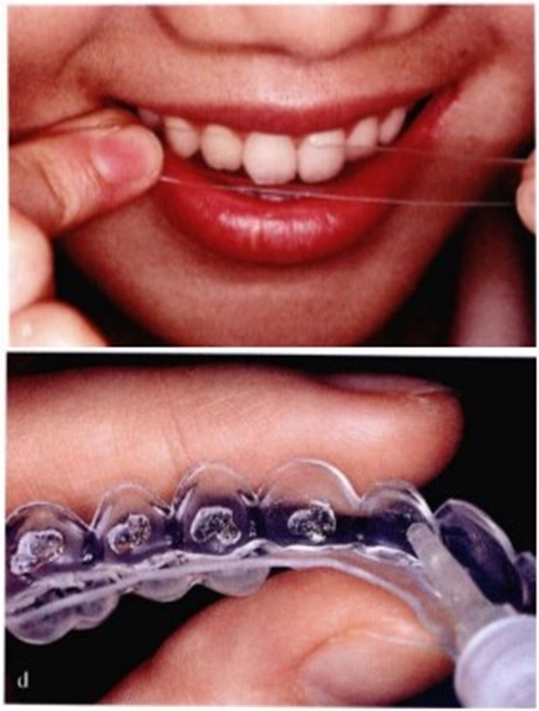 美白牙齿不伤牙齿的方法,牙齿黄不好看怎么美容