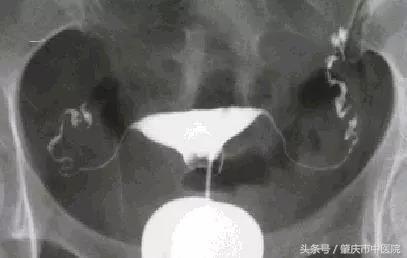 妇科小知识妇科,查输卵管是否堵塞怎么查