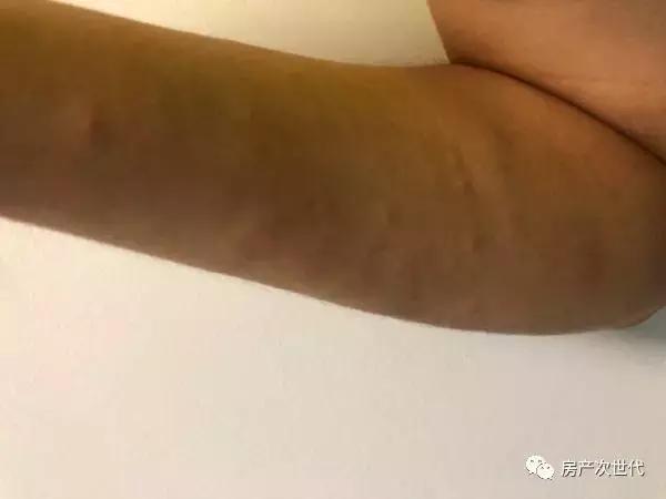 头昏、失眠、全身红疹、不能维权，我住的可是最贵的自如寓！