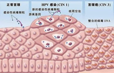 发现hpv阳性但是已经怀孕了怎么办,发现hpv高危险怎么办