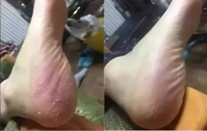 脚部干裂起皮用它一抹全搞定,脚后跟干裂好物推荐