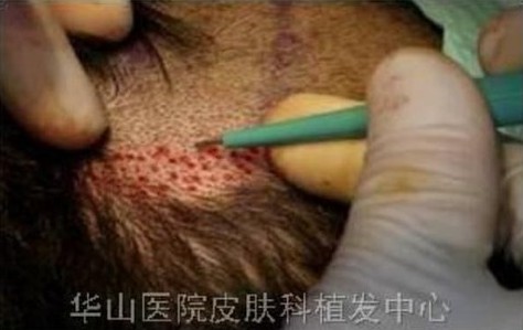 5个原因导致男人脱发,雄激素性脱发能治吗