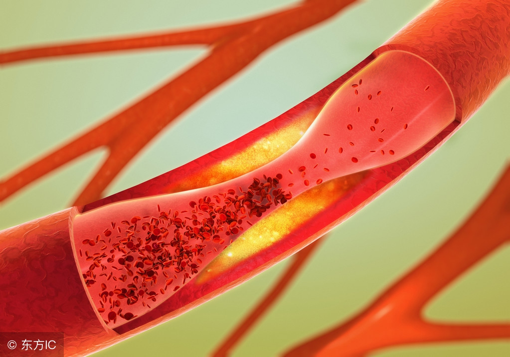 心血管为什么会变窄,心血管王医生判断心肌缺血