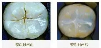 预防儿童龋齿涂氟还是窝沟封闭,有一点龋齿不想做窝沟封闭会怎样