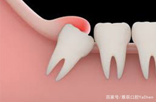 智齿为什么疼的时候不能拔,智齿疼为什么不能拔