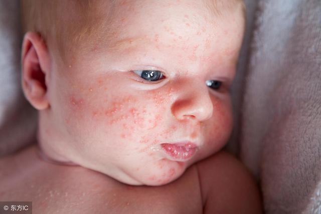 床上螨虫多皮肤会有很多痘痘吗,床上的螨虫到底有多少