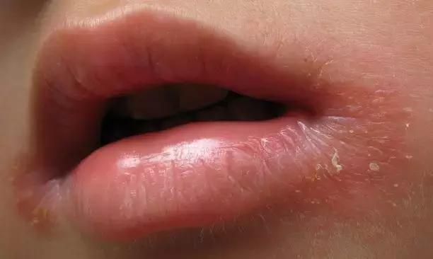 儿童口角湿疹用什么药,小孩干性皮肤湿疹怎么治