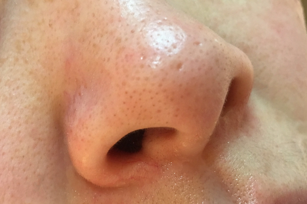 用黑头针去黑头后怎么收缩毛孔,用黑头夹子去黑头怎么打开毛孔