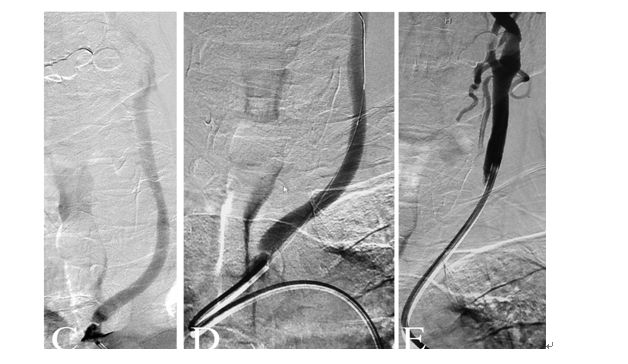 学术快报｜莫大鹏：颈动脉病变的复合手术治疗原则
